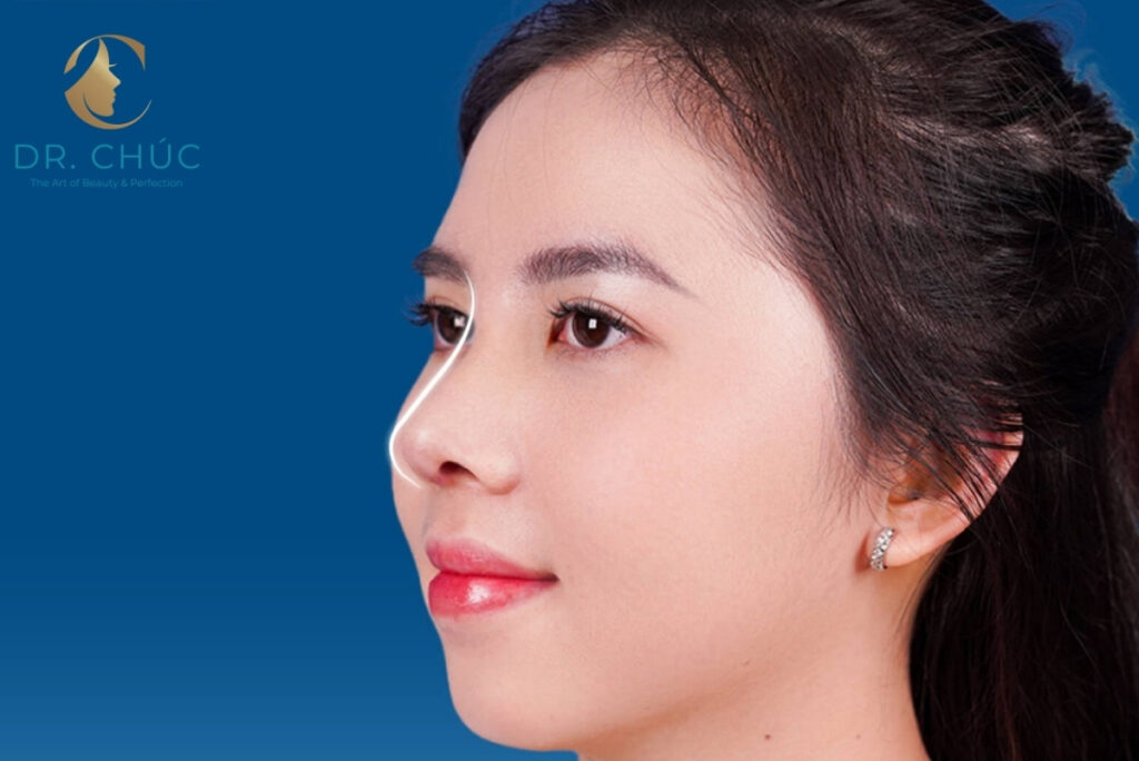 Nâng mũi S Line là gì?