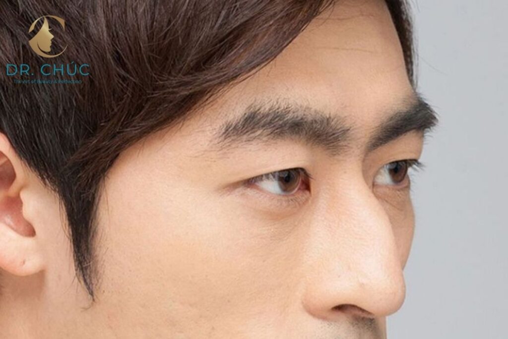 Nguyên nhân mũi bị gồ phổ biến hiện nay