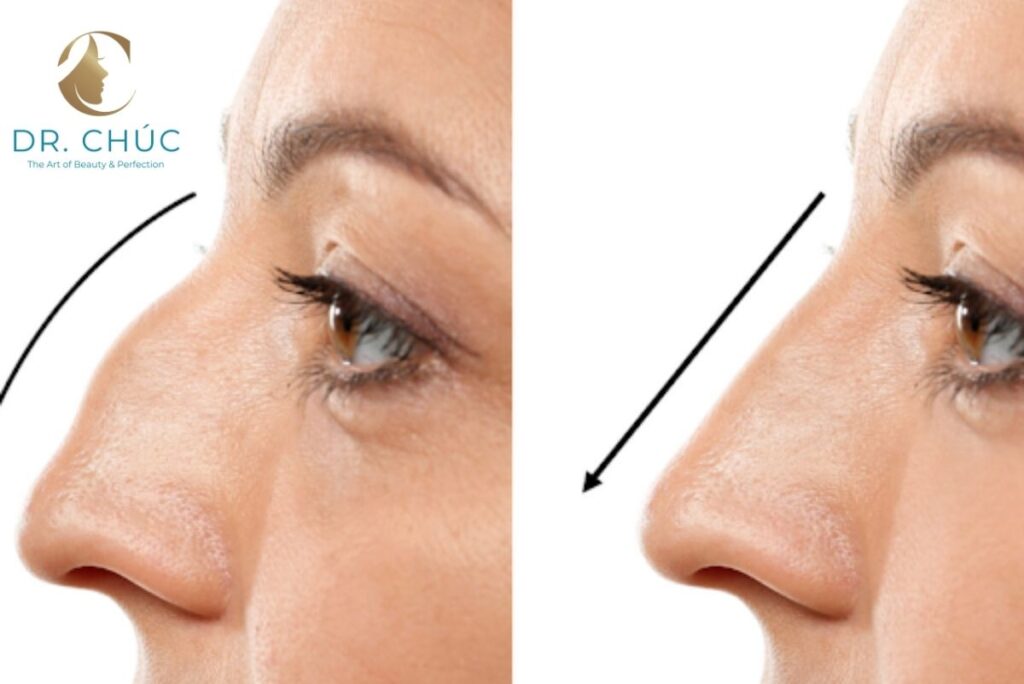 Tai nạn hoặc chấn thương vùng mũi