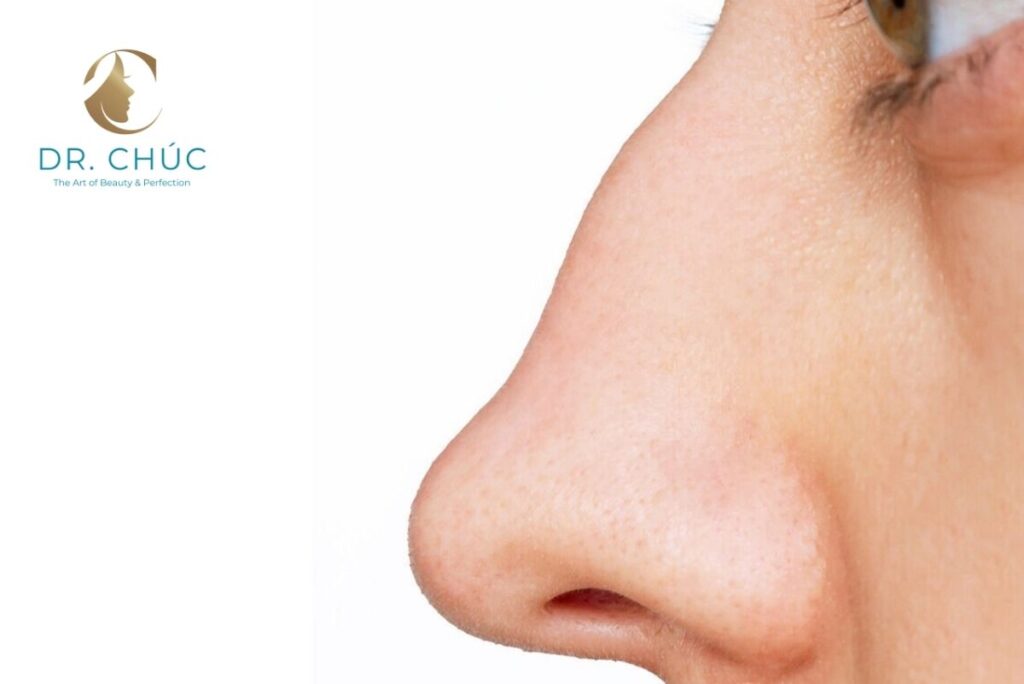 Mũi bị gồ là gì?