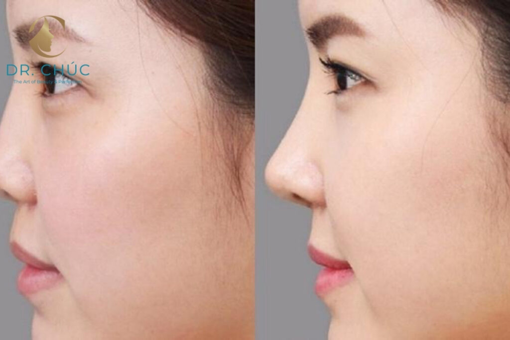 Phẫu thuật nâng mũi là gì? Hiểu đúng để làm đẹp an toàn