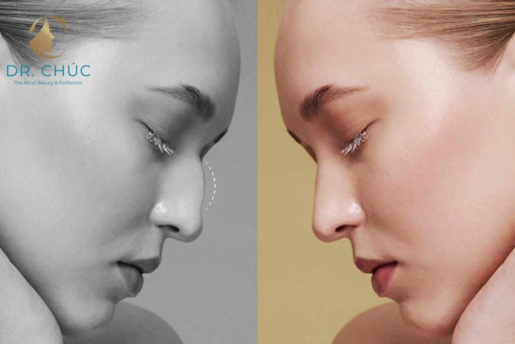 Phẫu thuật nâng mũi có ảnh hưởng gì đến sức khỏe không?
