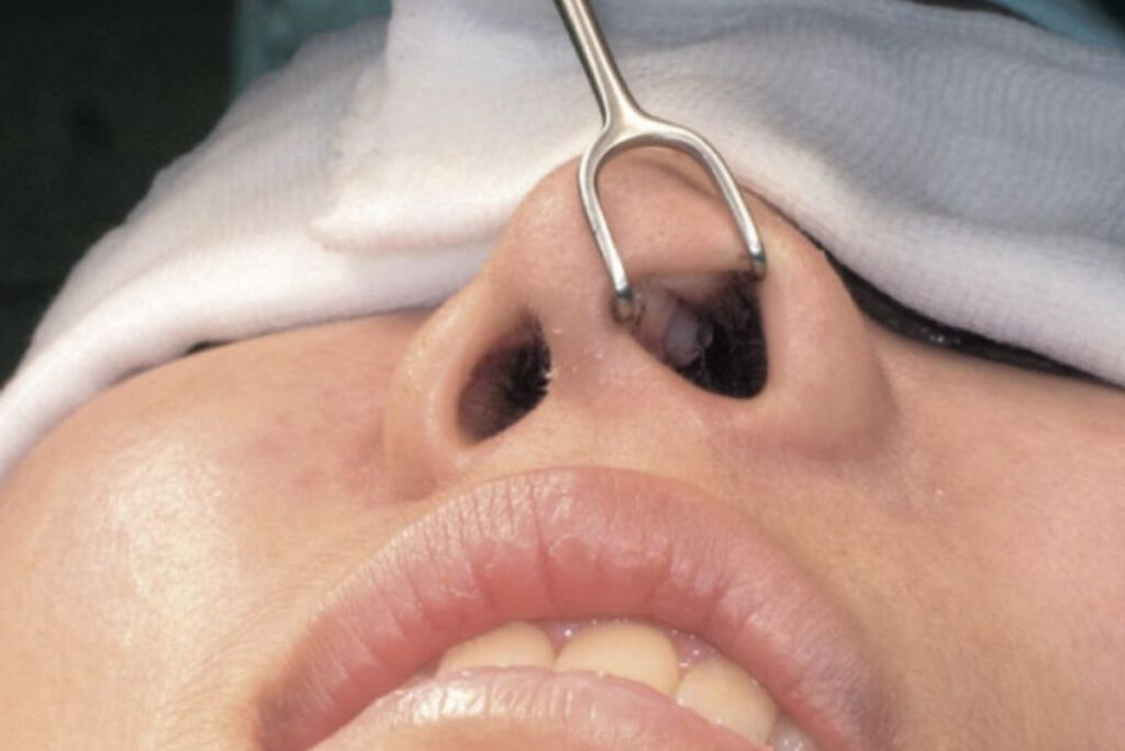 Khi nào cần thực hiện quy trình tháo sụn mũi