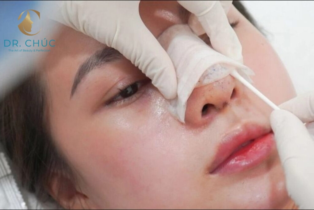 Các bước trong quy trình tháo sụn mũi tiêu chuẩn