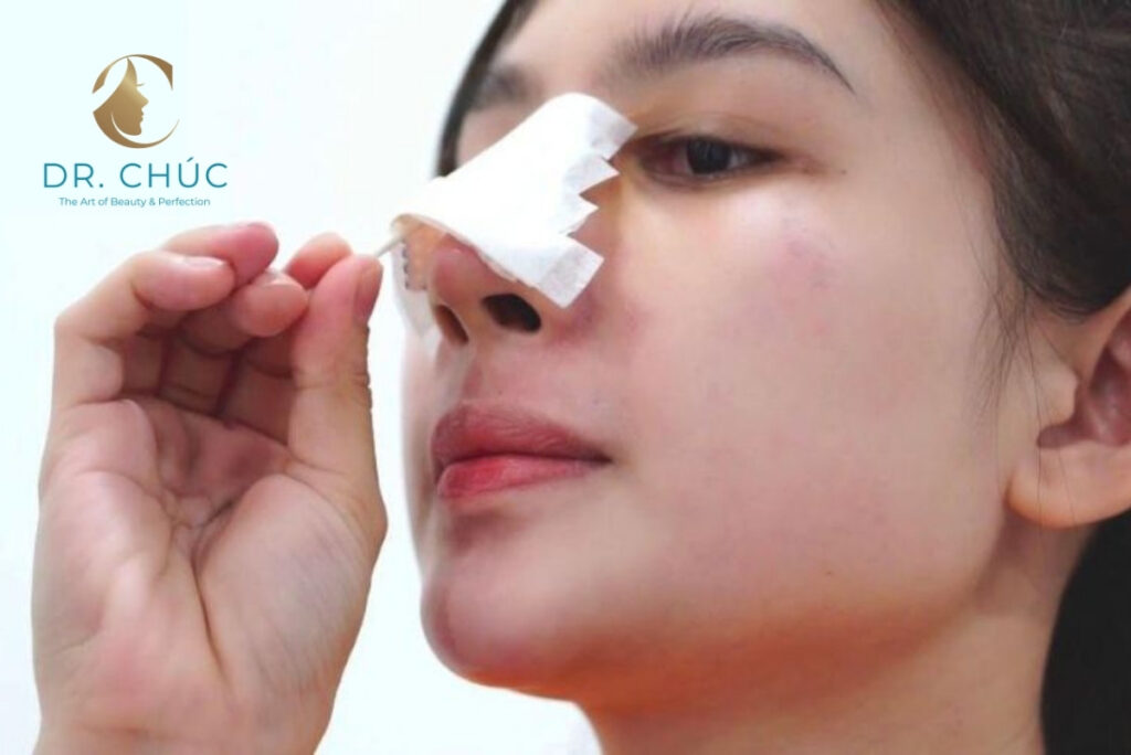 Mũi có trở lại bình thường sau khi tháo sụn không?