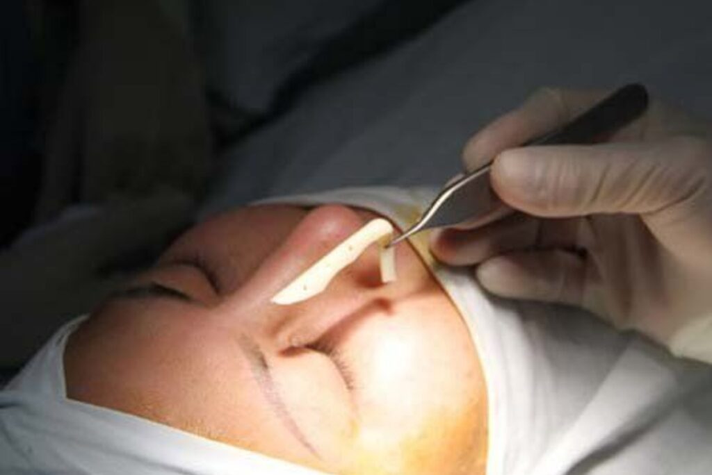 Thời gian hồi phục sau khi thực hiện quy trình tháo sụn mũi