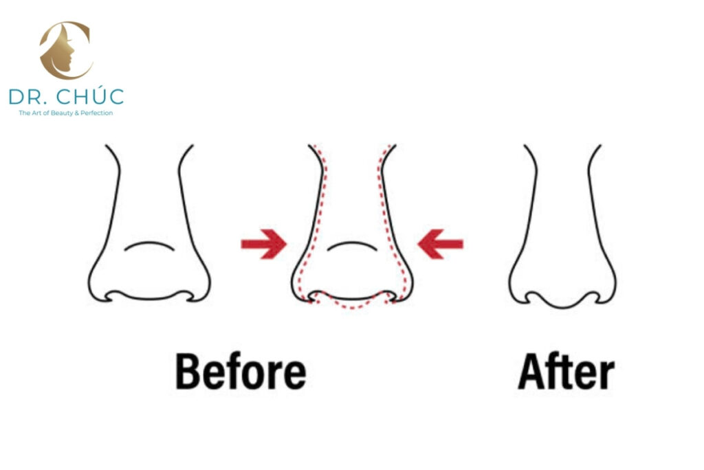 Cân chỉnh cánh mũi có đau không? Câu trả lời chân thực