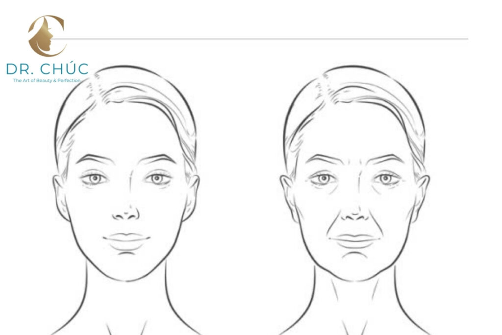 Nâng nền cánh mũi là gì?