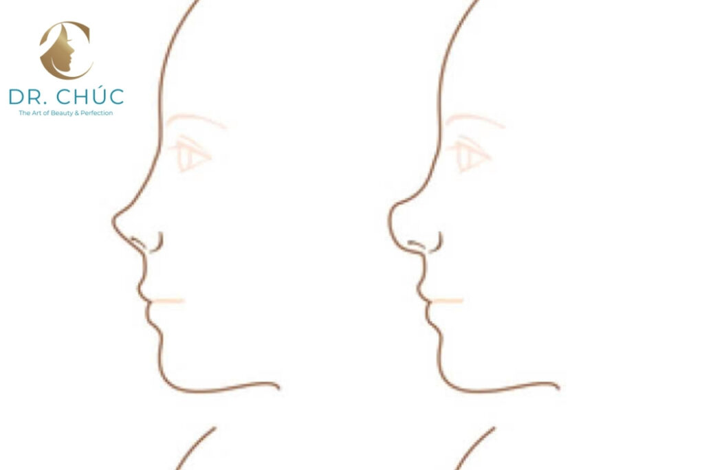 Hõm đầu mũi là gì và tại sao nhiều người quan tâm?