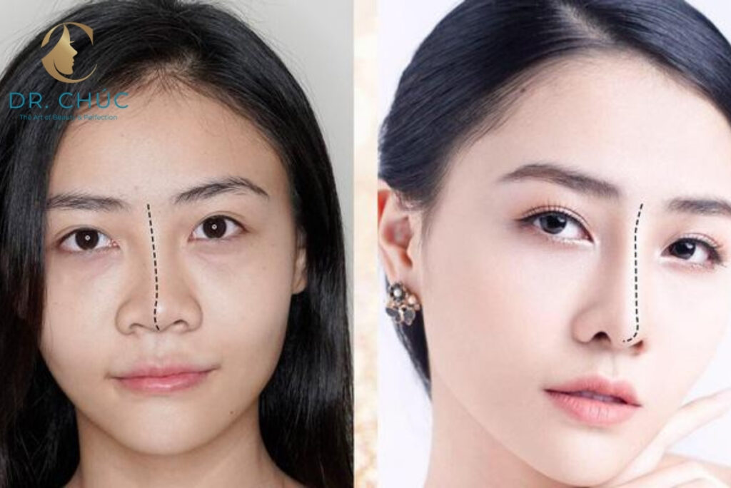 Tác động và sự nghiêm trọng của tình trạng nâng mũi bị hở vết thương