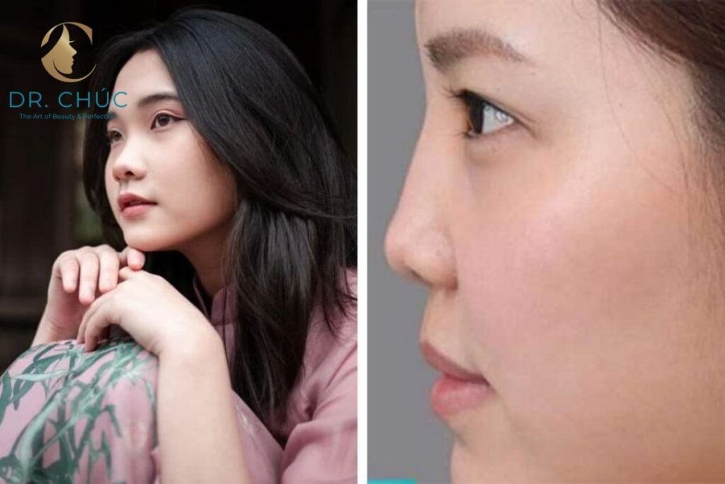 Mũi tẹt ảnh hưởng như thế nào đến cuộc sống?