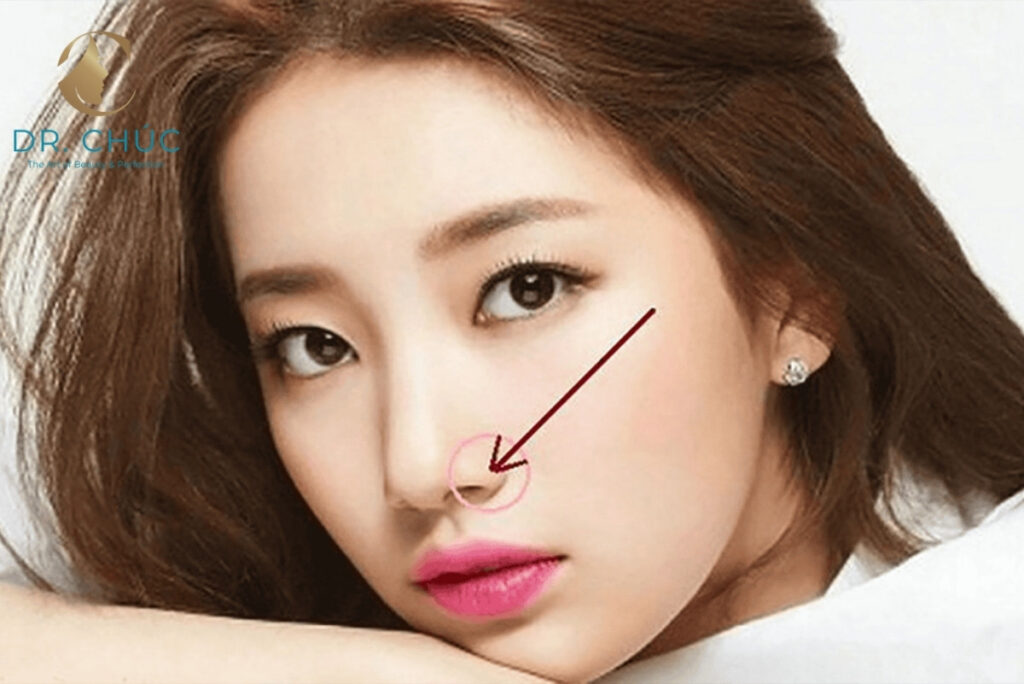 Thu gọn cánh mũi là gì? Ai nên thực hiện?