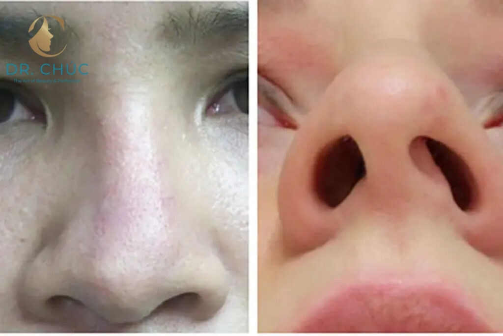 Những biến chứng thường gặp sau khi thu gọn cánh mũi