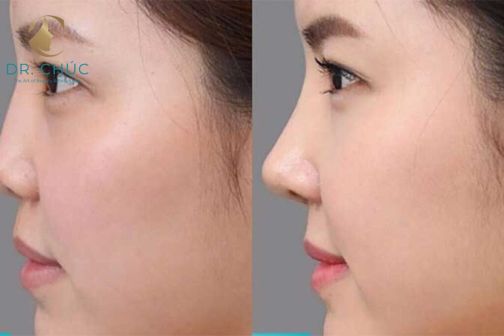 Vuốt mũi hay phẫu thuật – đâu là giải pháp hiệu quả?