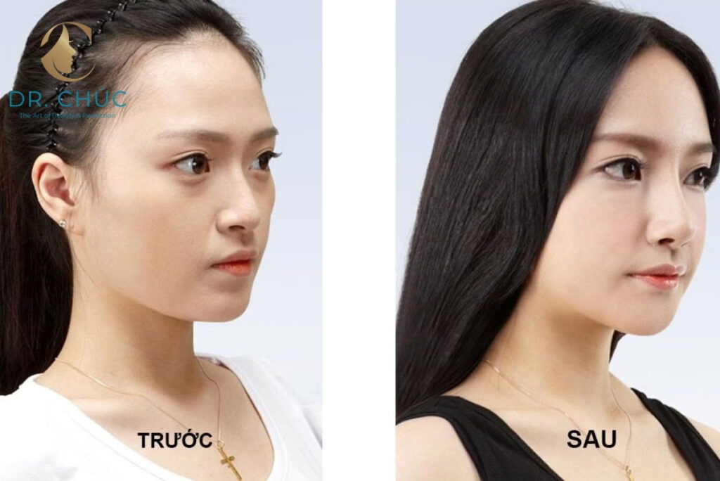 Nâng mũi là gì và vì sao cần đặc biệt cẩn trọng?