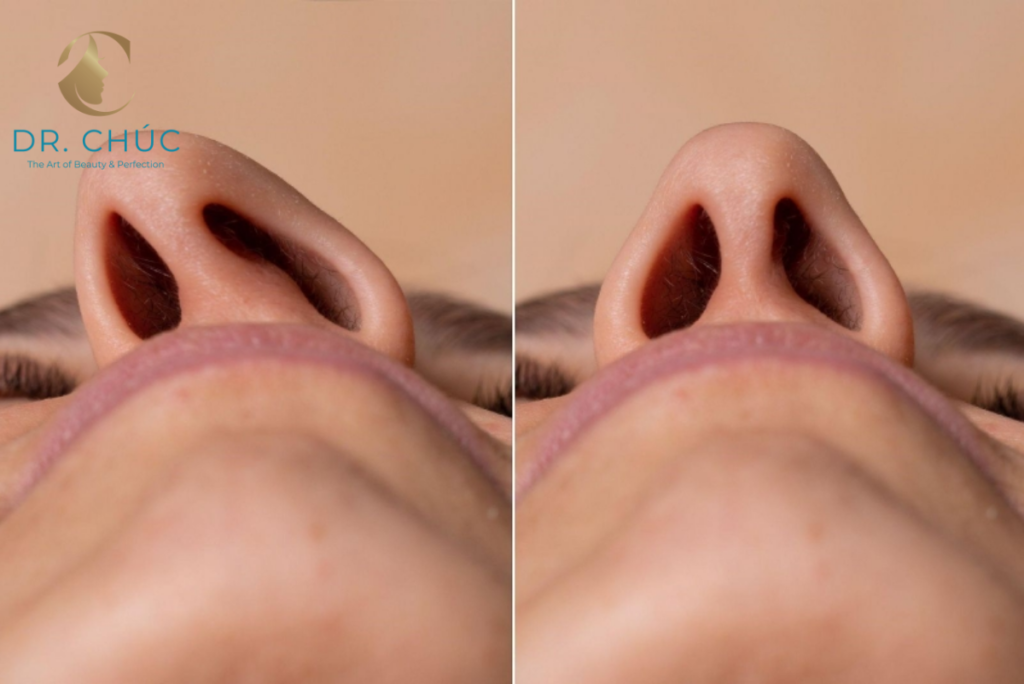 Vách ngăn mũi là gì và vai trò trong phẫu thuật nâng mũi