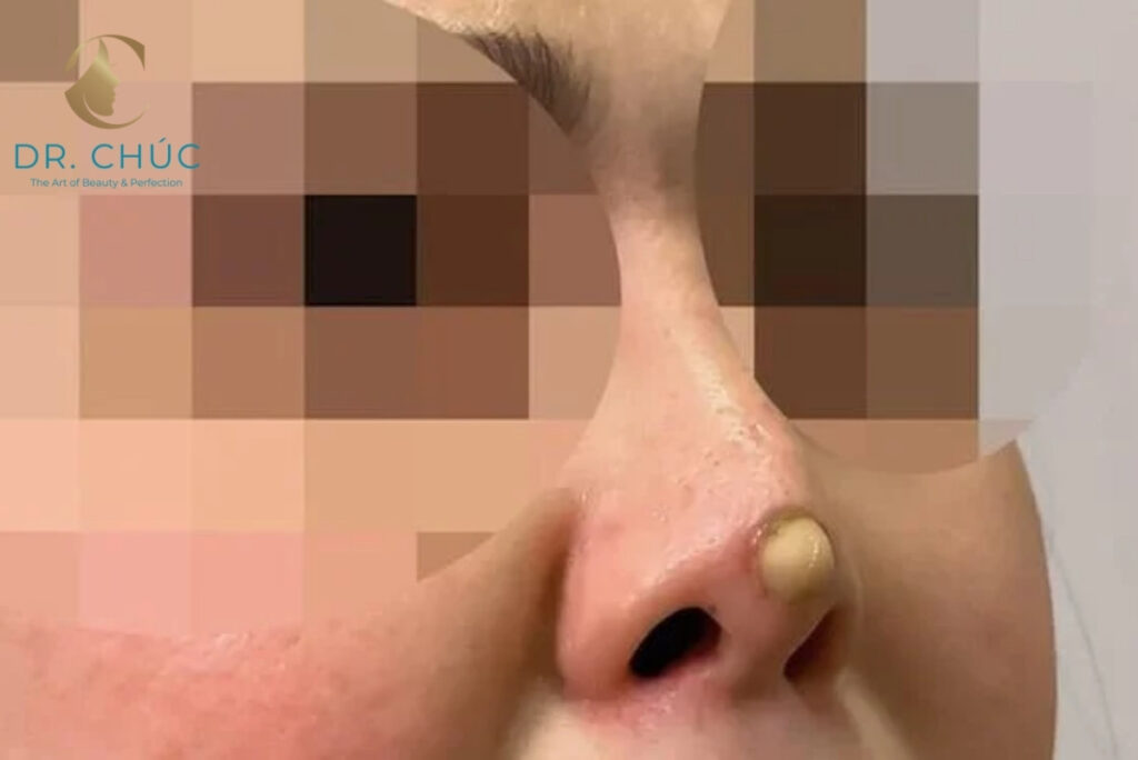 Biểu hiện nhận biết nâng mũi bị lòi sụn bên trong