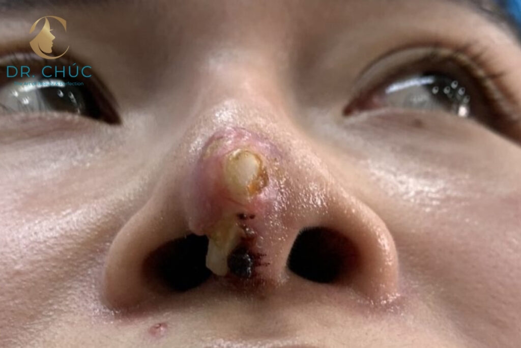 Nguyên nhân gây nâng mũi bị lòi sụn bên trong