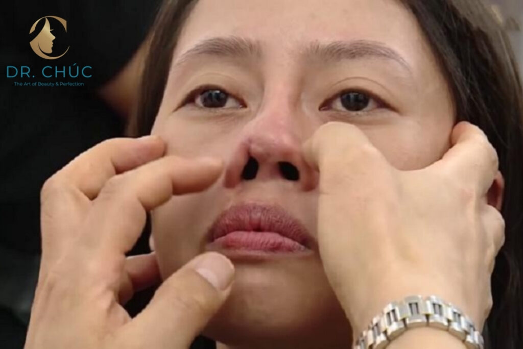 Cách khắc phục nâng mũi bị lòi sụn bên trong hiệu quả