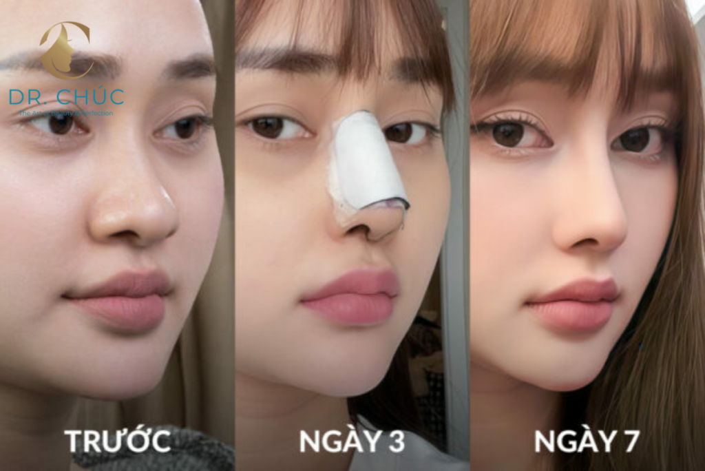 Sự khác biệt giữa sụn Surgiform và sụn Silicon truyền thống