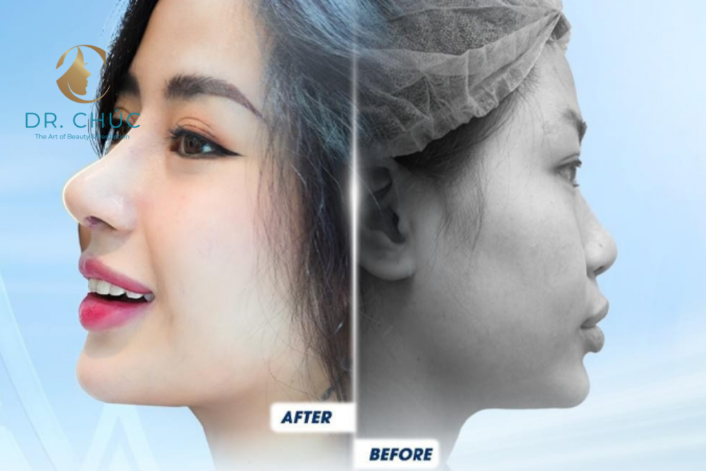 Nâng mũi Surgiform có tốt không?