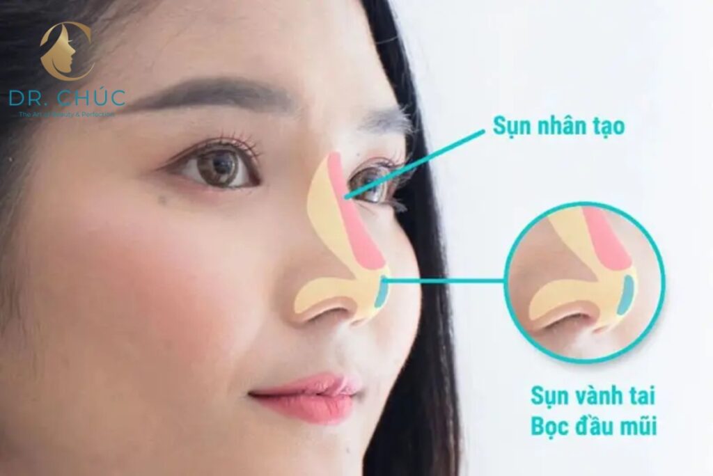 Những ai không nên nâng mũi bằng sụn tai?