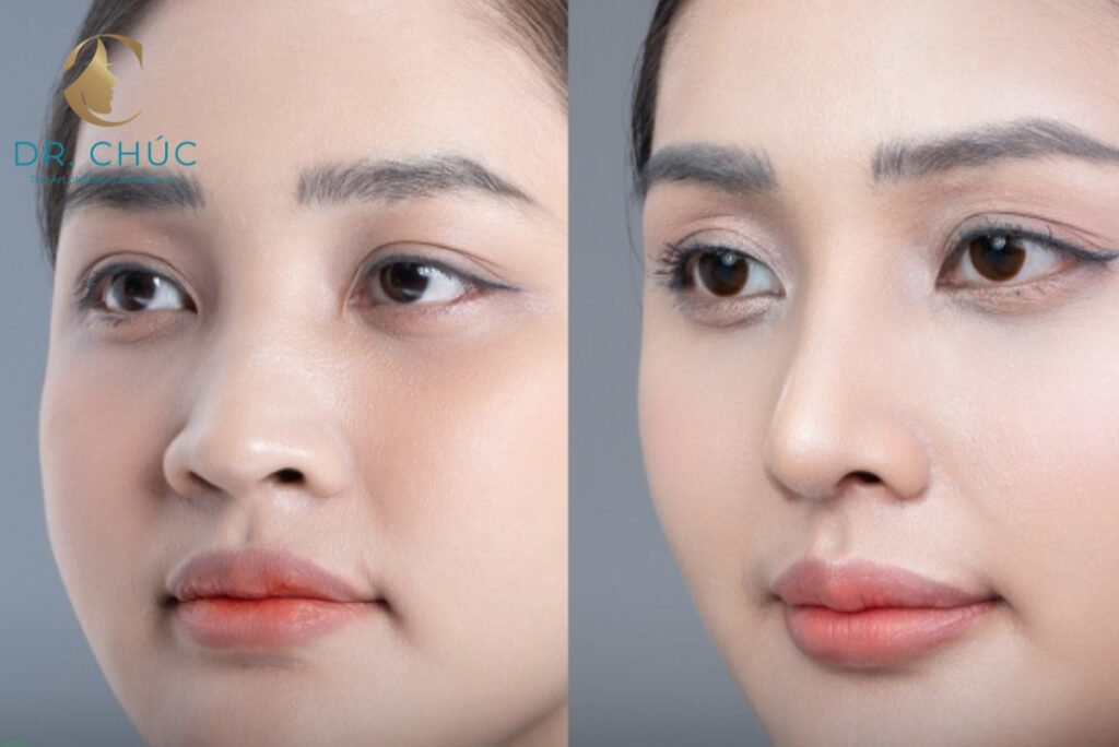 Thu gọn xương mũi bè có phải là nâng mũi không?