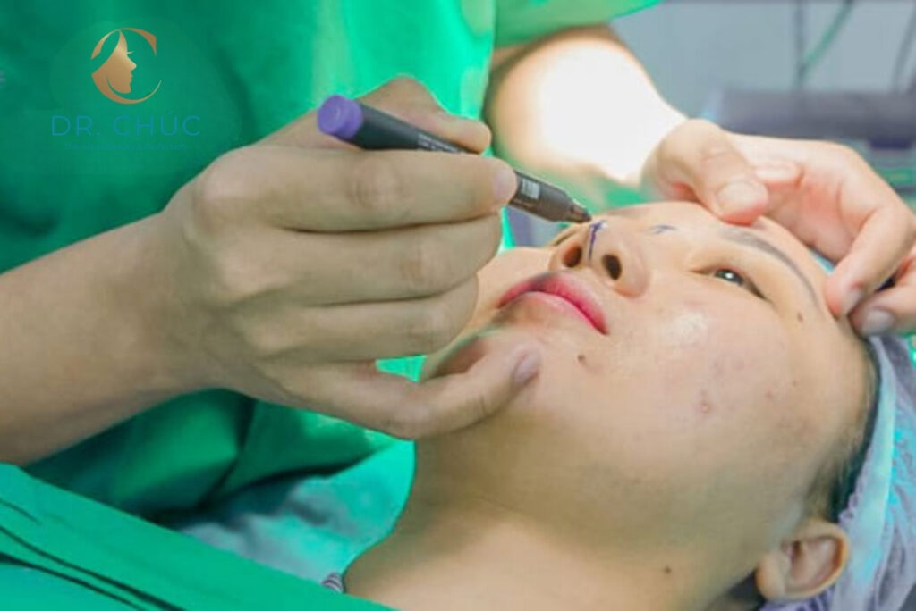 Thu gọn xương mũi bè có phải là nâng mũi không?