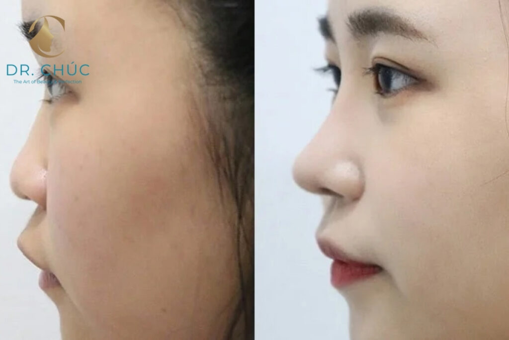 Vì sao thu gọn xương mũi bè cần bác sĩ chuyên sâu?