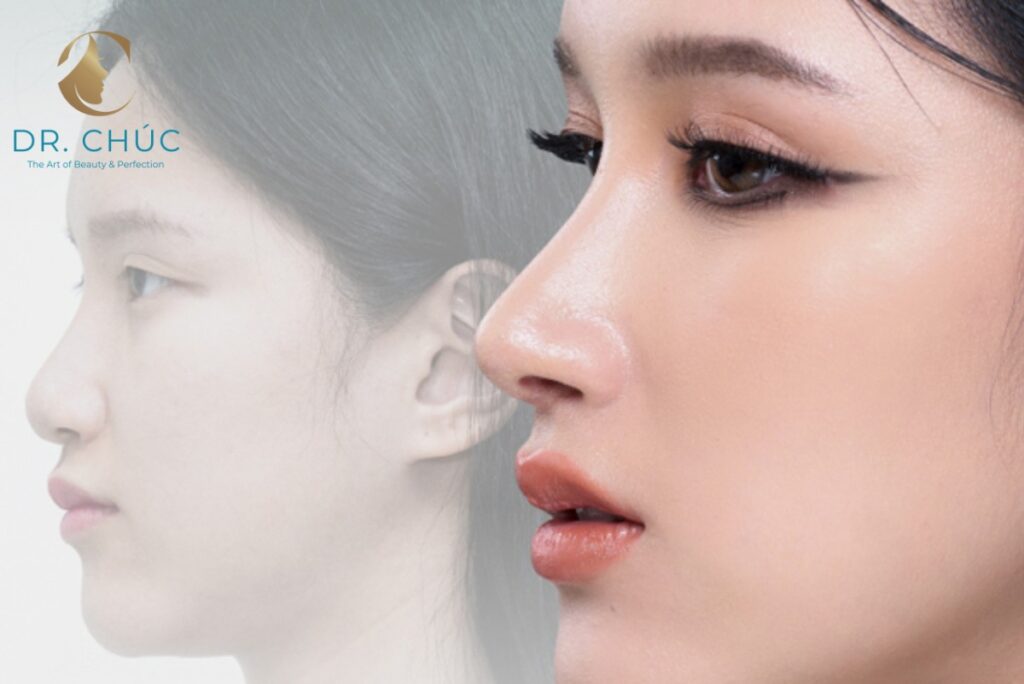 Có nên thu gọn xương mũi bè không?