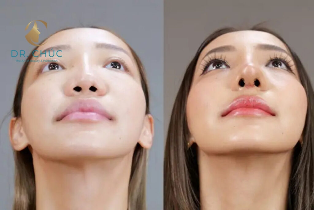 Vì sao tụt sụn mũi sau phẫu thuật cần được xử lý sớm?