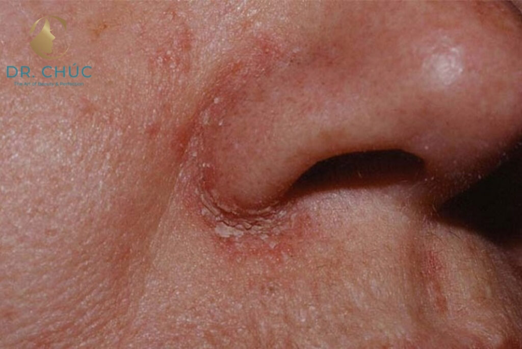 Vết khâu nâng mũi đóng vảy có nguy hiểm không?