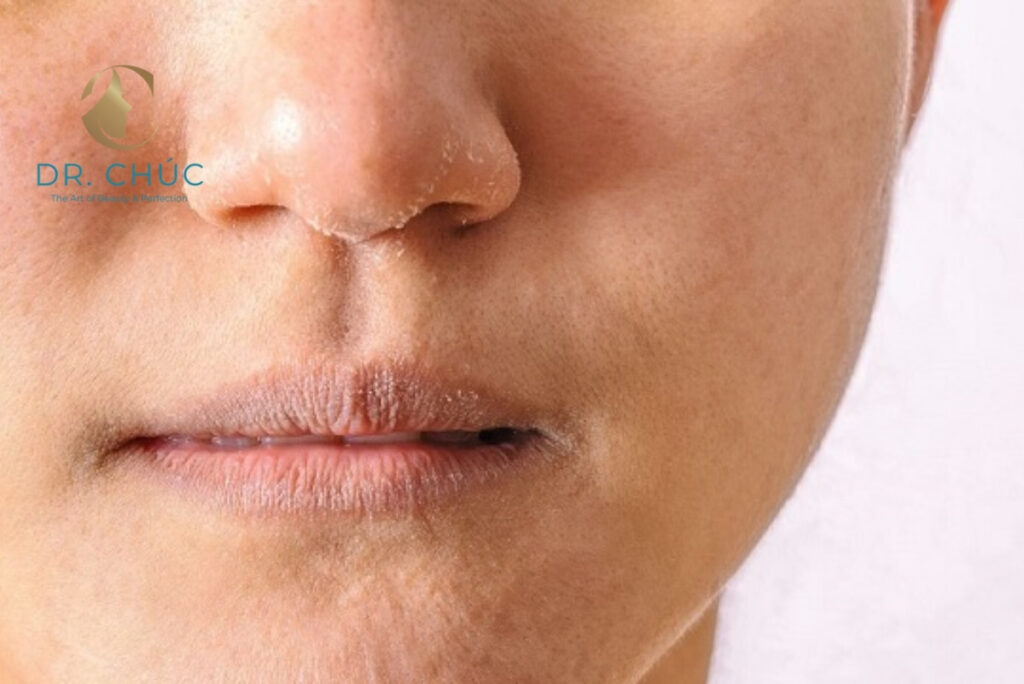 Ảnh hưởng của vết khâu nâng mũi đóng vảy đến kết quả thẩm mỹ