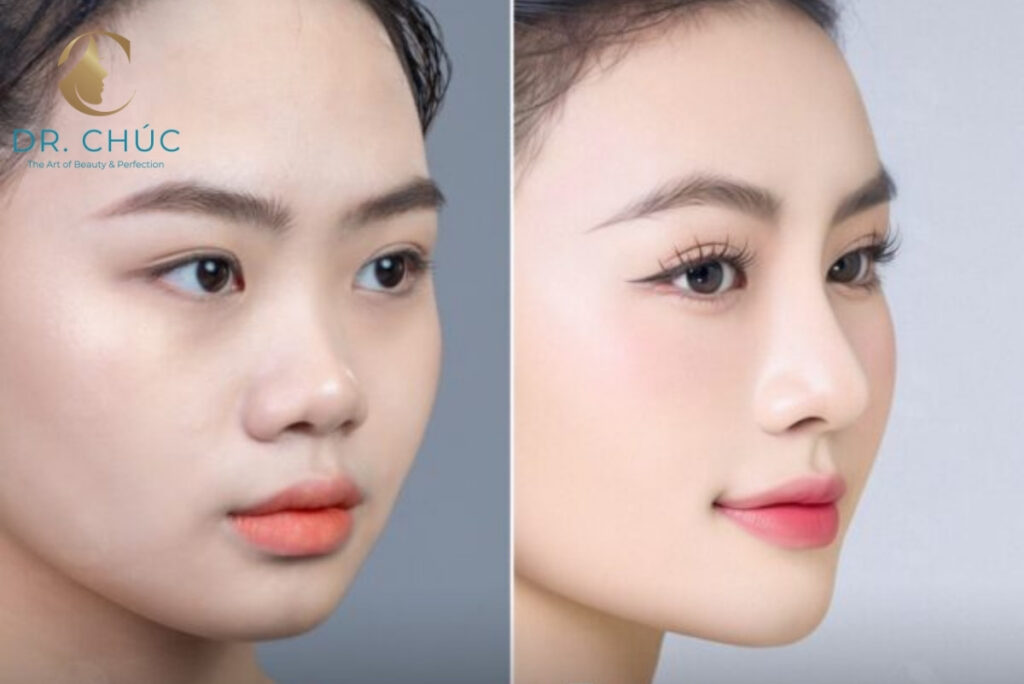 Nâng mũi S-line là gì?