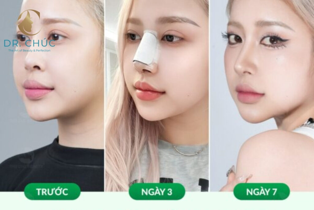 Các yếu tố quyết định độ bền của nâng mũi S-line