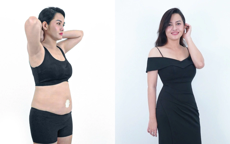 Hút mỡ Pro J-Plasma