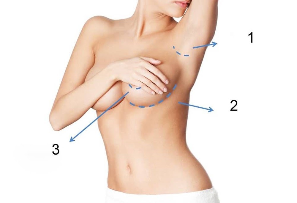 Nâng ngực đặt túi