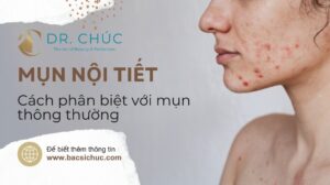 Mụn nội tiết: Cách phân biệt với mụn thông thường