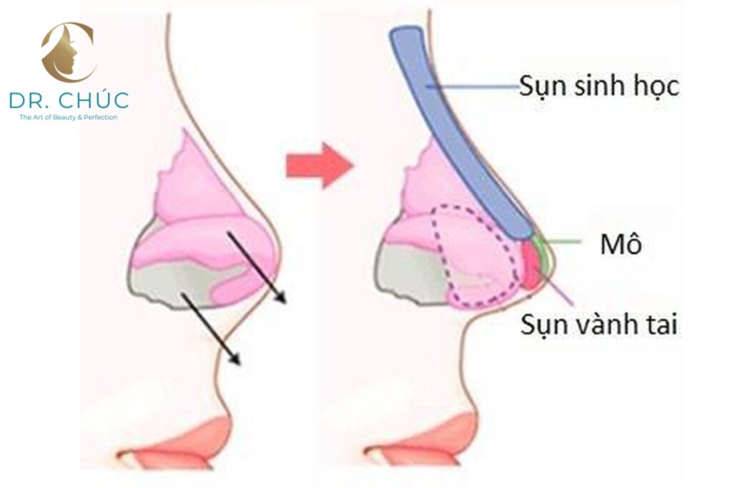 Sự thật về nâng mũi cấu trúc để được cả đời