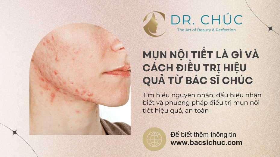 Mụn nội tiết là gì và cách điều trị hiệu quả từ Bác sĩ Chúc