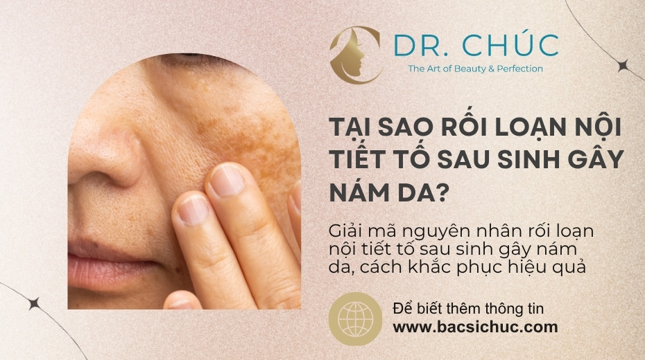 Giải mã bí ẩn “rối loạn nội tiết tố sau sinh gây nám da”