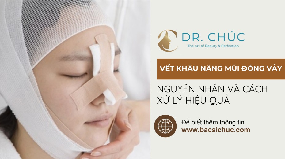 Vết khâu nâng mũi đóng vảy: Nguyên nhân và cách xử lý hiệu quả